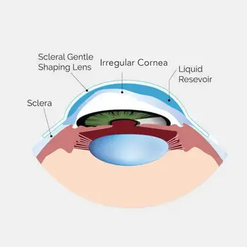 Scleral contact lens for keratoconus cambridge